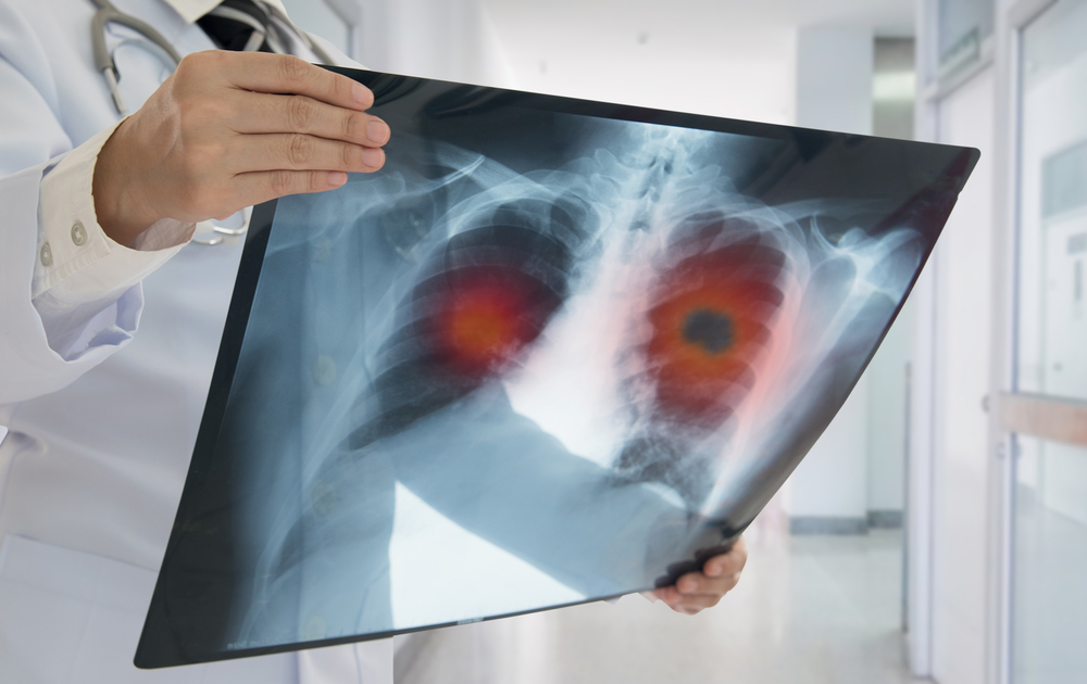 Misdiagnosis of Lung Cancer or Delay Diagnosis of Lung Cancer