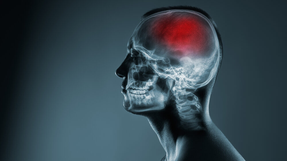 Pittsburgh Failure to Diagnose Stroke Lawyer