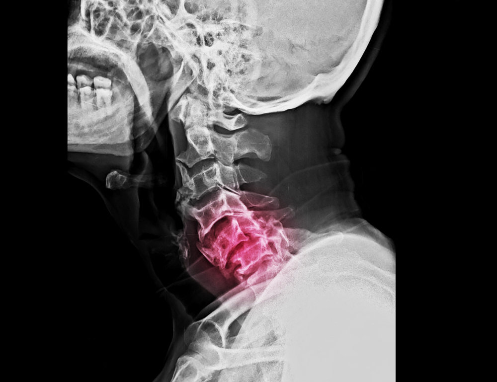 How Car Accidents Can Cause Spinal Cord Injuries 