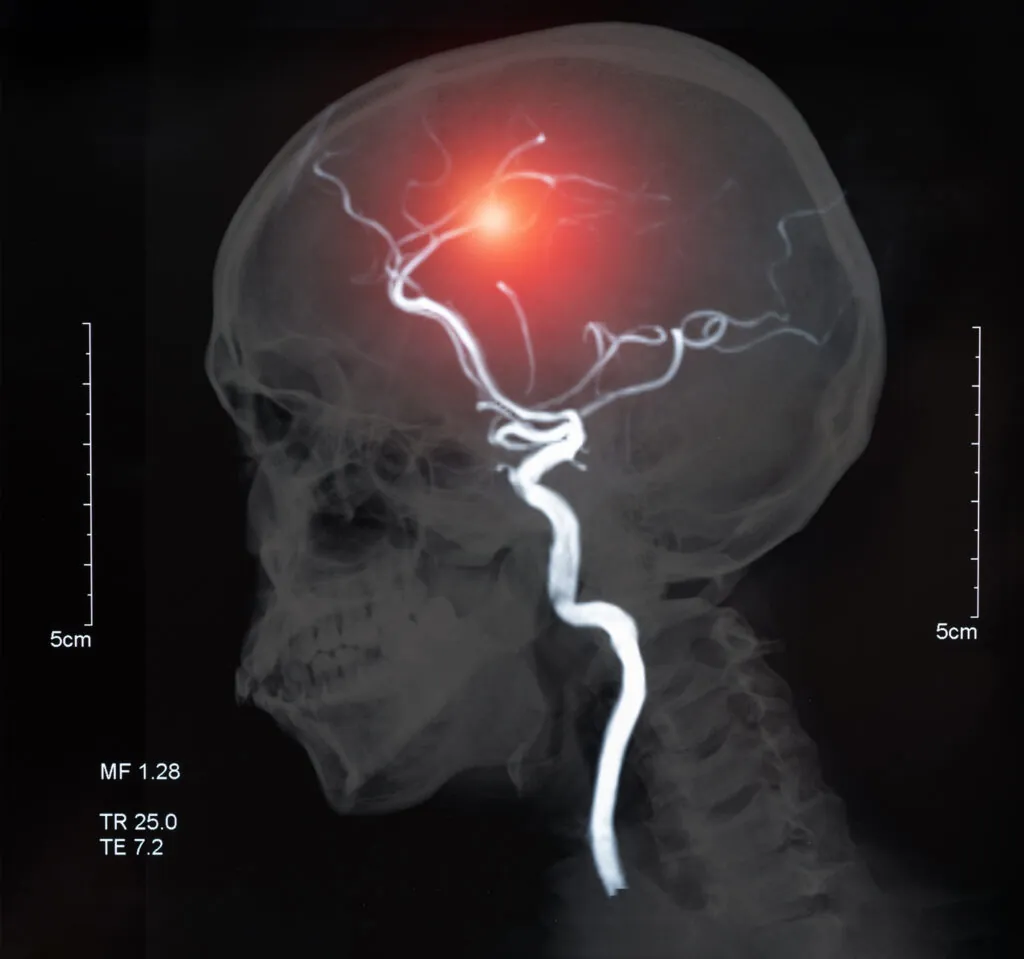 Emergency Room Malpractice: Failure to Diagnose Stroke