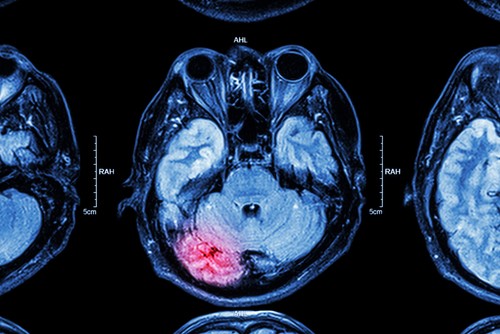 ER Doctors Often Fail to Diagnose Brain Injuries