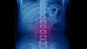 Misdiagnosed Cauda Equina Syndrome Attorney in Pittsburgh, PA
