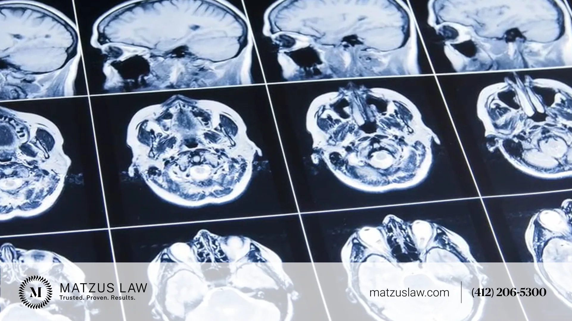 Brain Injury