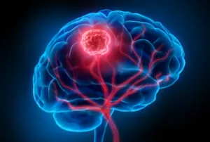 Carcinoid Tumor Attorney in Pittsburgh, PA 