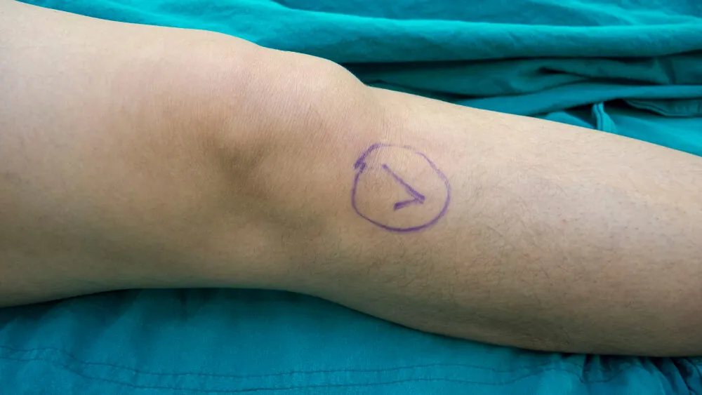 Pittsburgh Wrong-Site Surgery Lawyers
