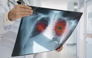 Lung Cancer Misdiagnosis Attorney in Pittsburgh, PA