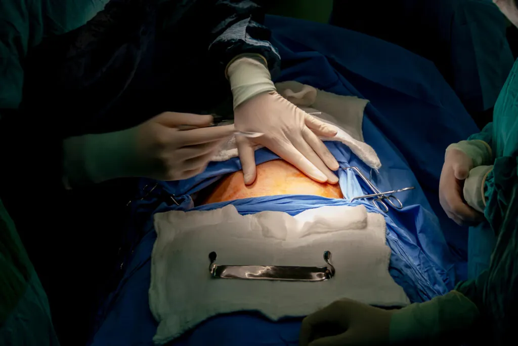 Legal Implications of Failure to Perform a Timely C-Section in PA